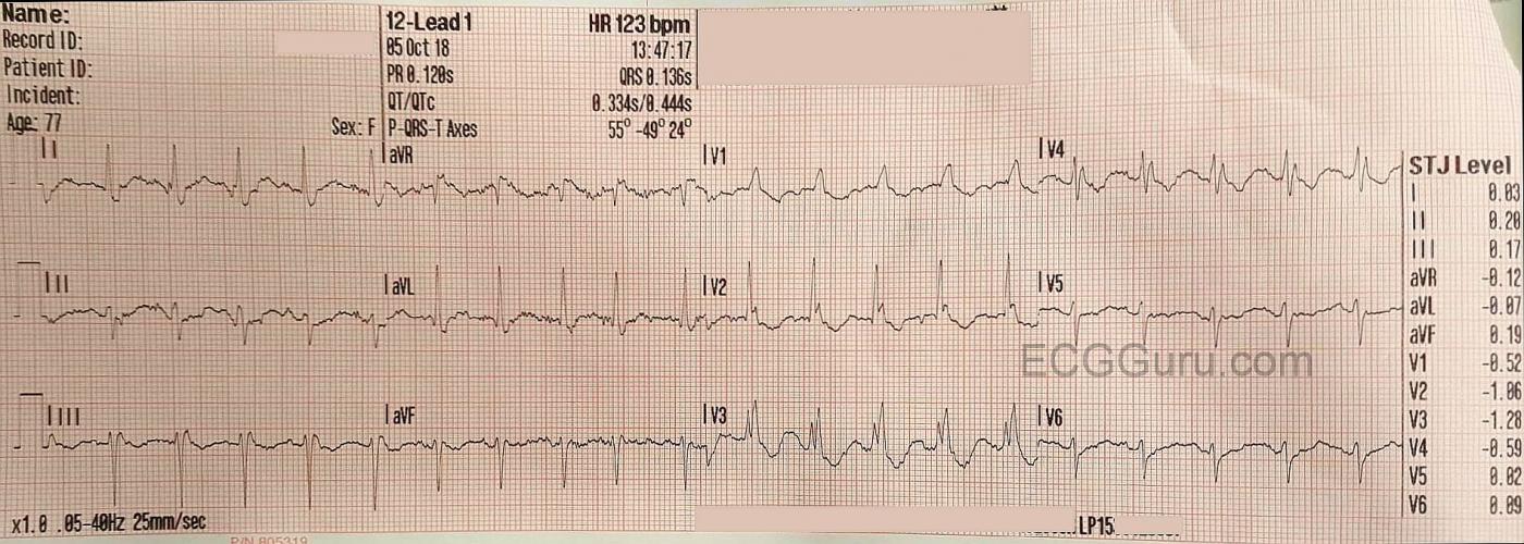 Bifascicular Block ECG Guru Instructor Resources